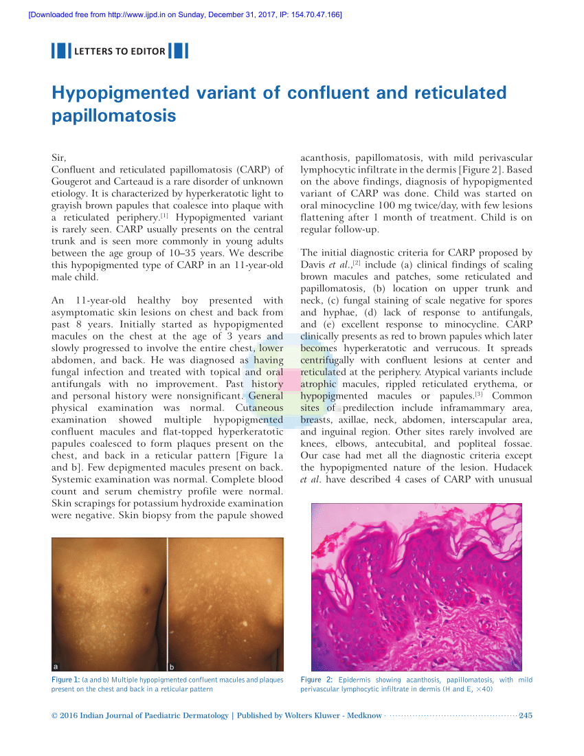 hypopigmented confluent and reticulated papillomatosis