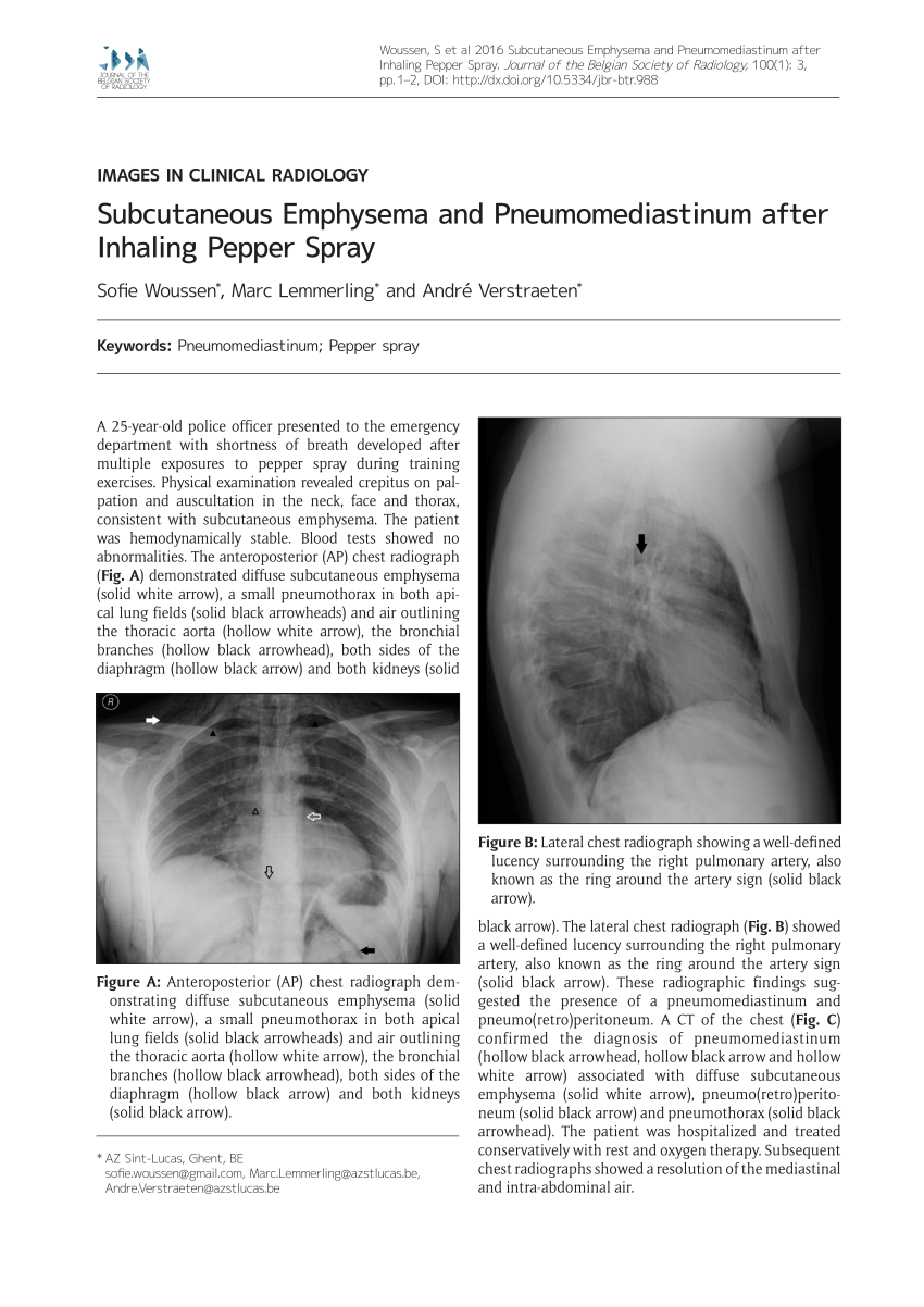 PDF Subcutaneous Emphysema And Pneumomediastinum After Inhaling