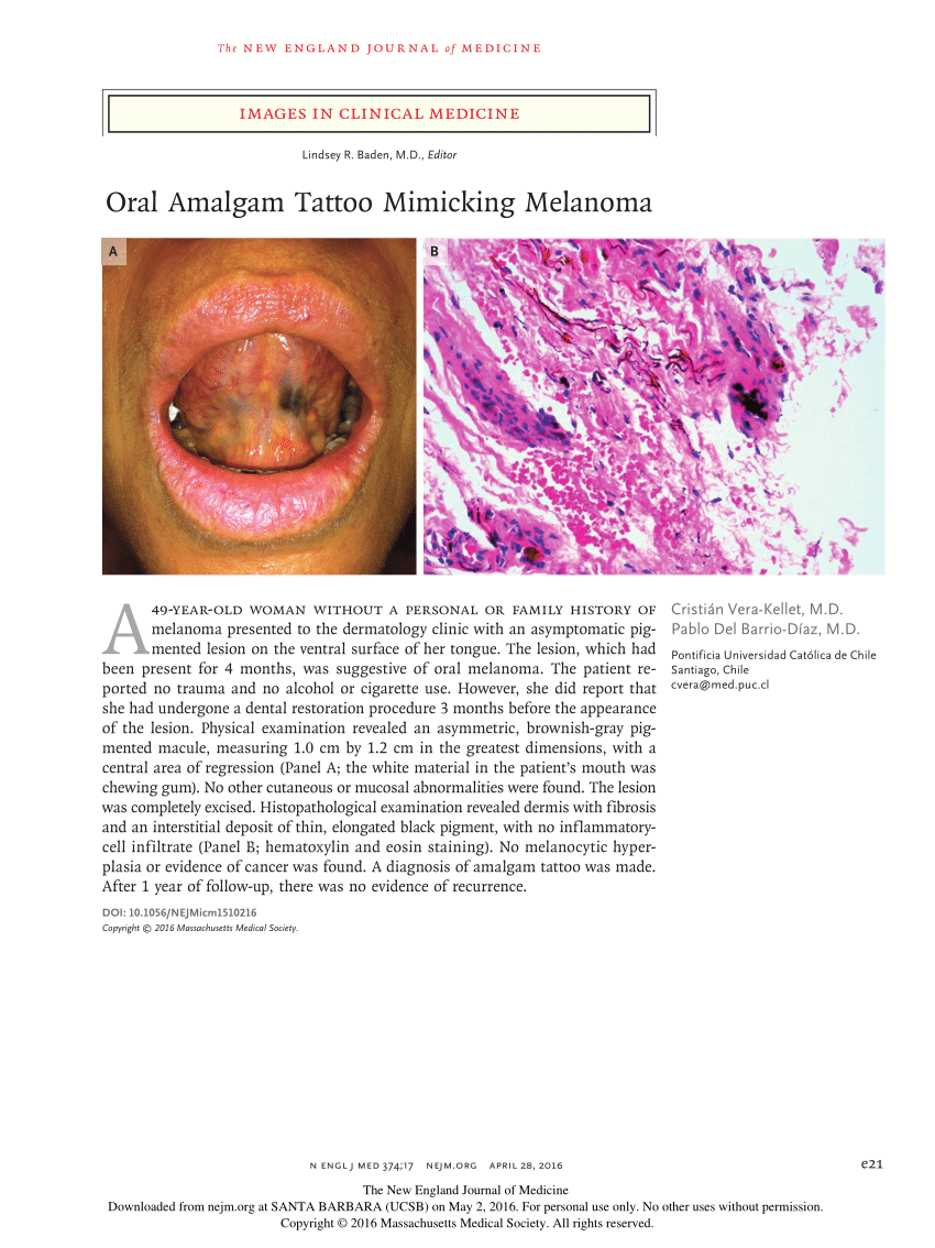 PDF) Oral Amalgam Tattoo Mimicking Melanoma