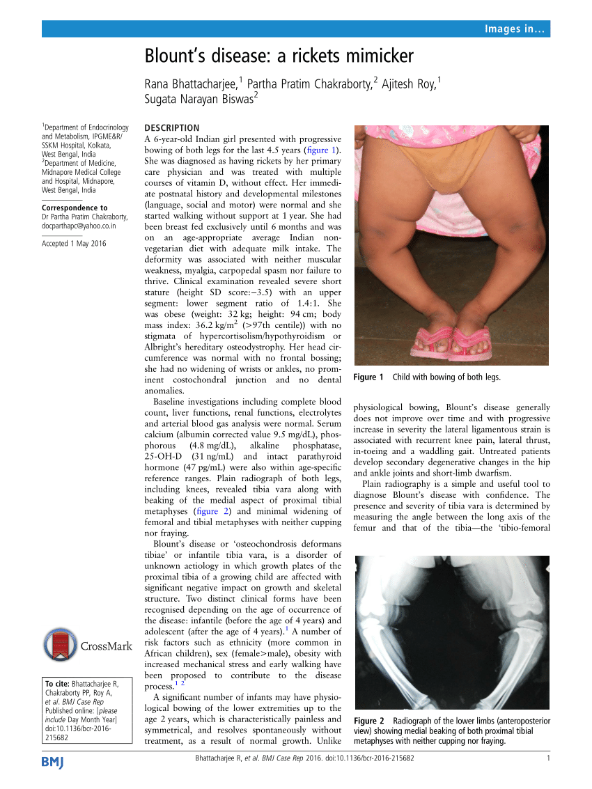 PDF] Tibia vara or Blount's disease: Why an early diagnosis and