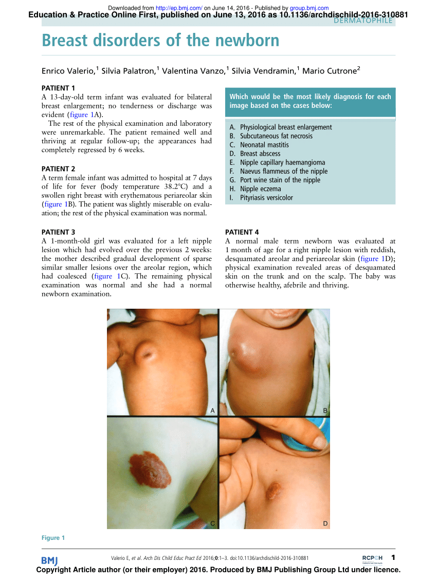 PDF] Persistence of Neonatal Breast Enlargement/Variant of Premature  Thelarche in a 3-Year-Old Girl - A Case Report