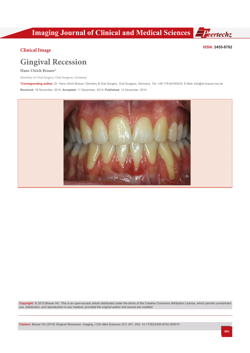 Pdf Gingival Recession