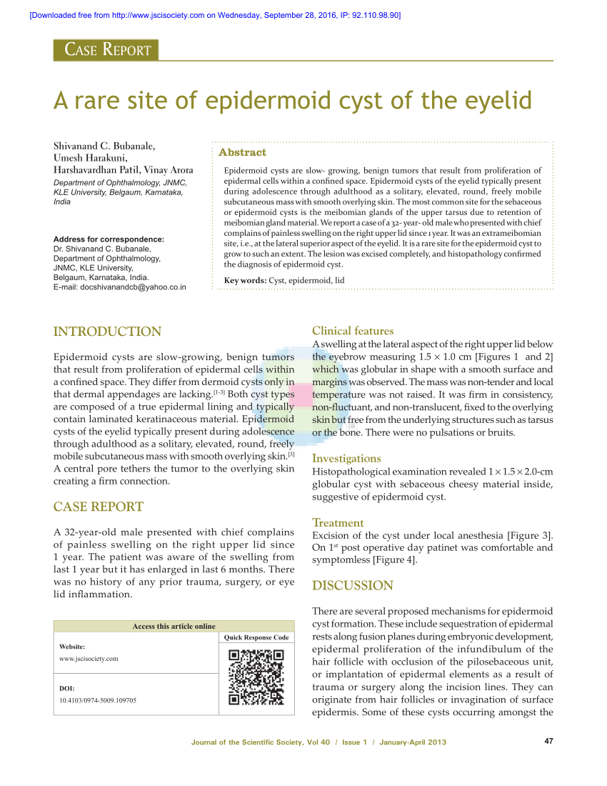 pdf-a-rare-site-of-epidermoid-cyst-of-the-eyelid