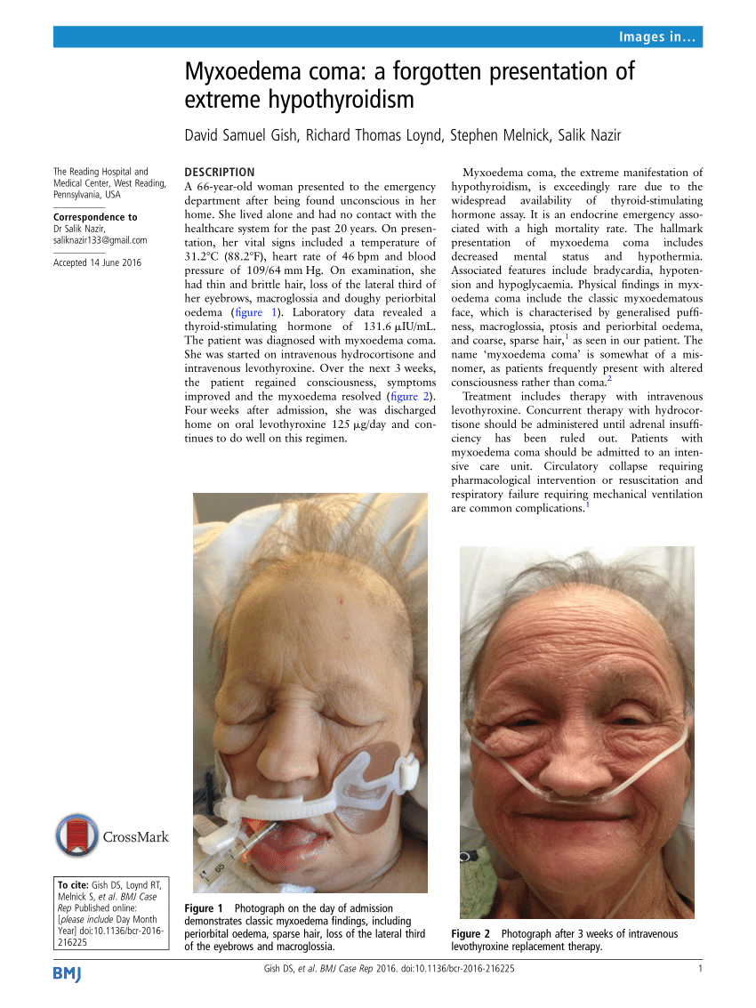 Pdf Myxoedema Coma A Forgotten Presentation Of Extreme Hypothyroidism