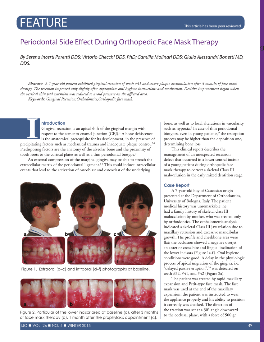 Pdf Periodontal Side Effect During Orthopedic Face Mask Therapy