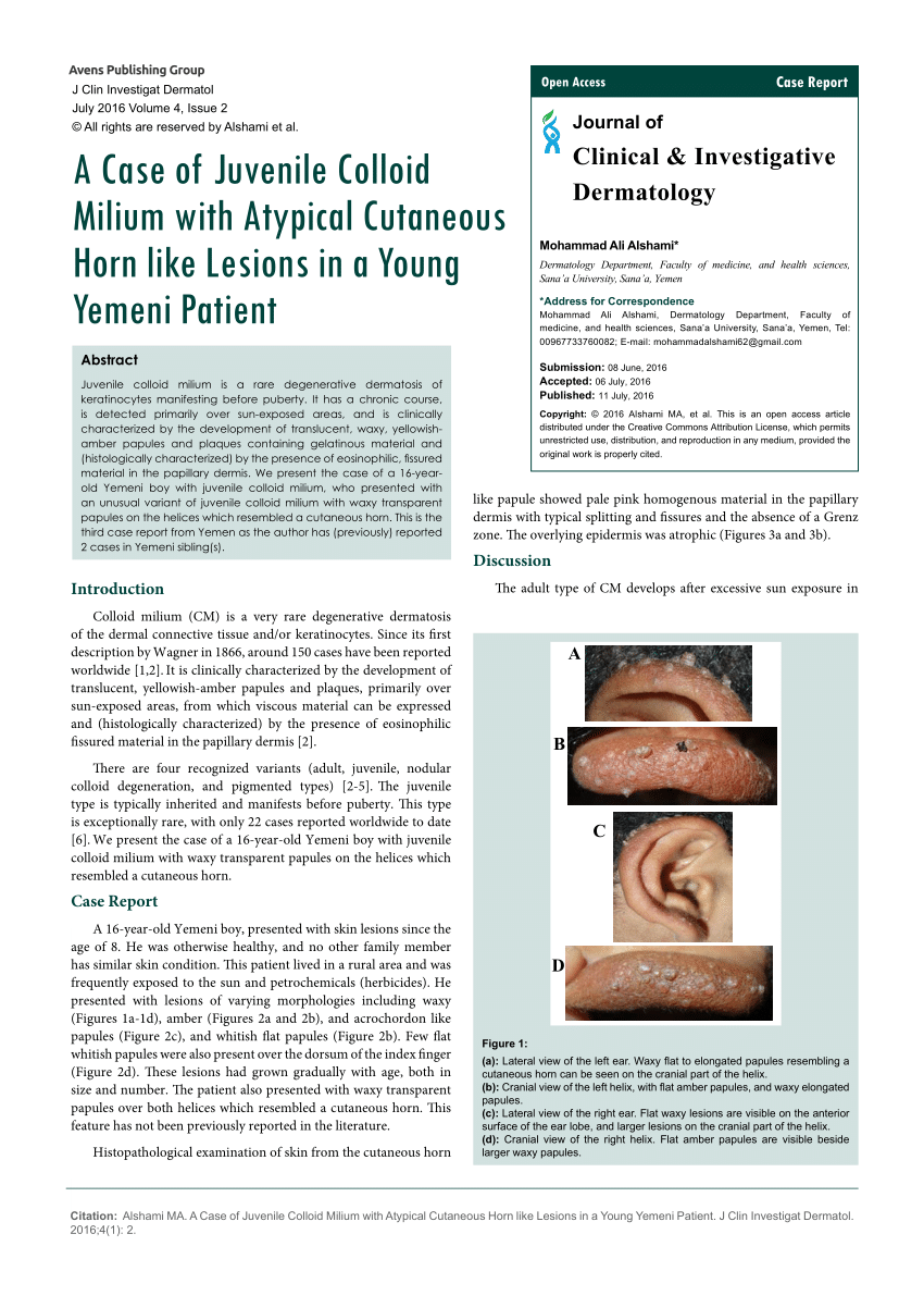 Pdf A Case Of Juvenile Colloid Milium With Atypical Cutaneous Horn