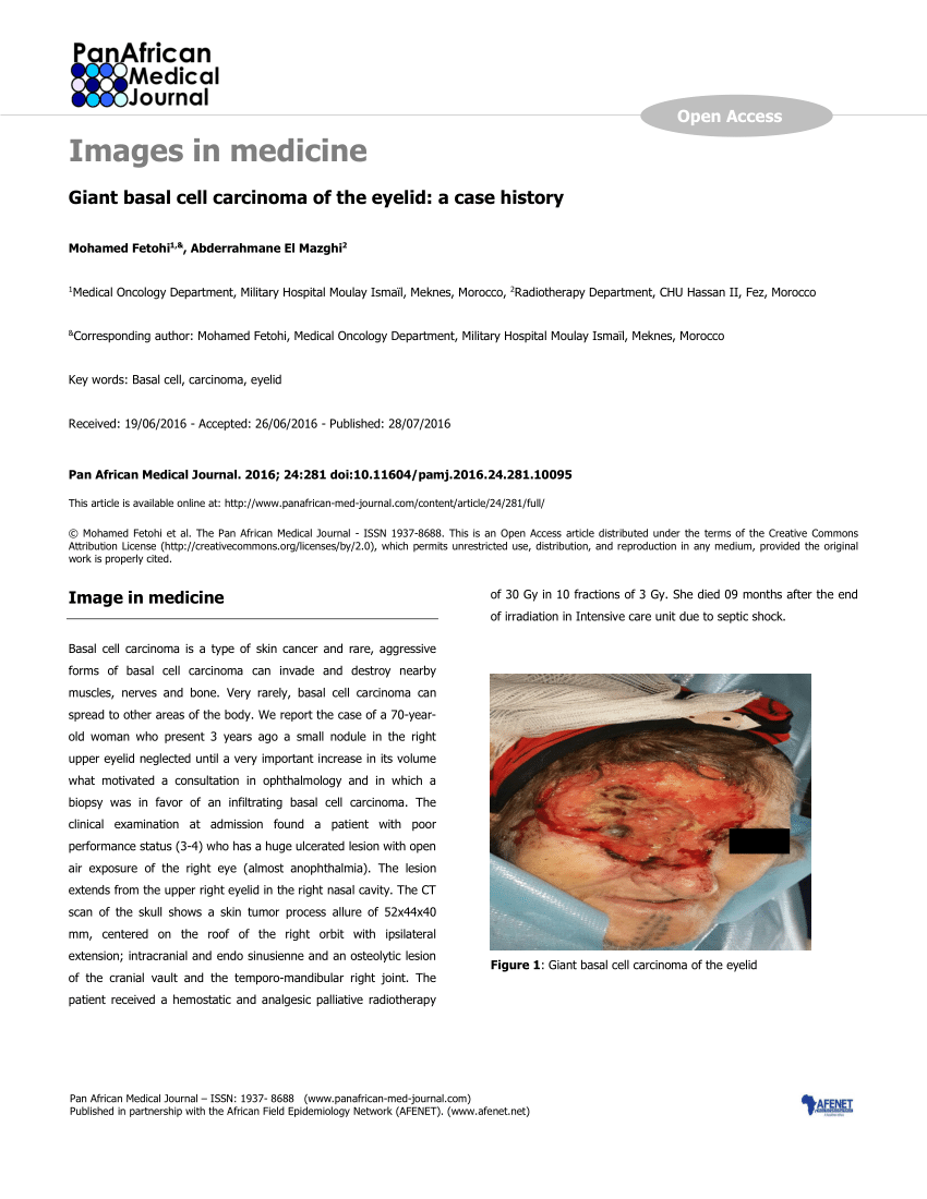 Pdf Giant Basal Cell Carcinoma Of The Eyelid A Case History 