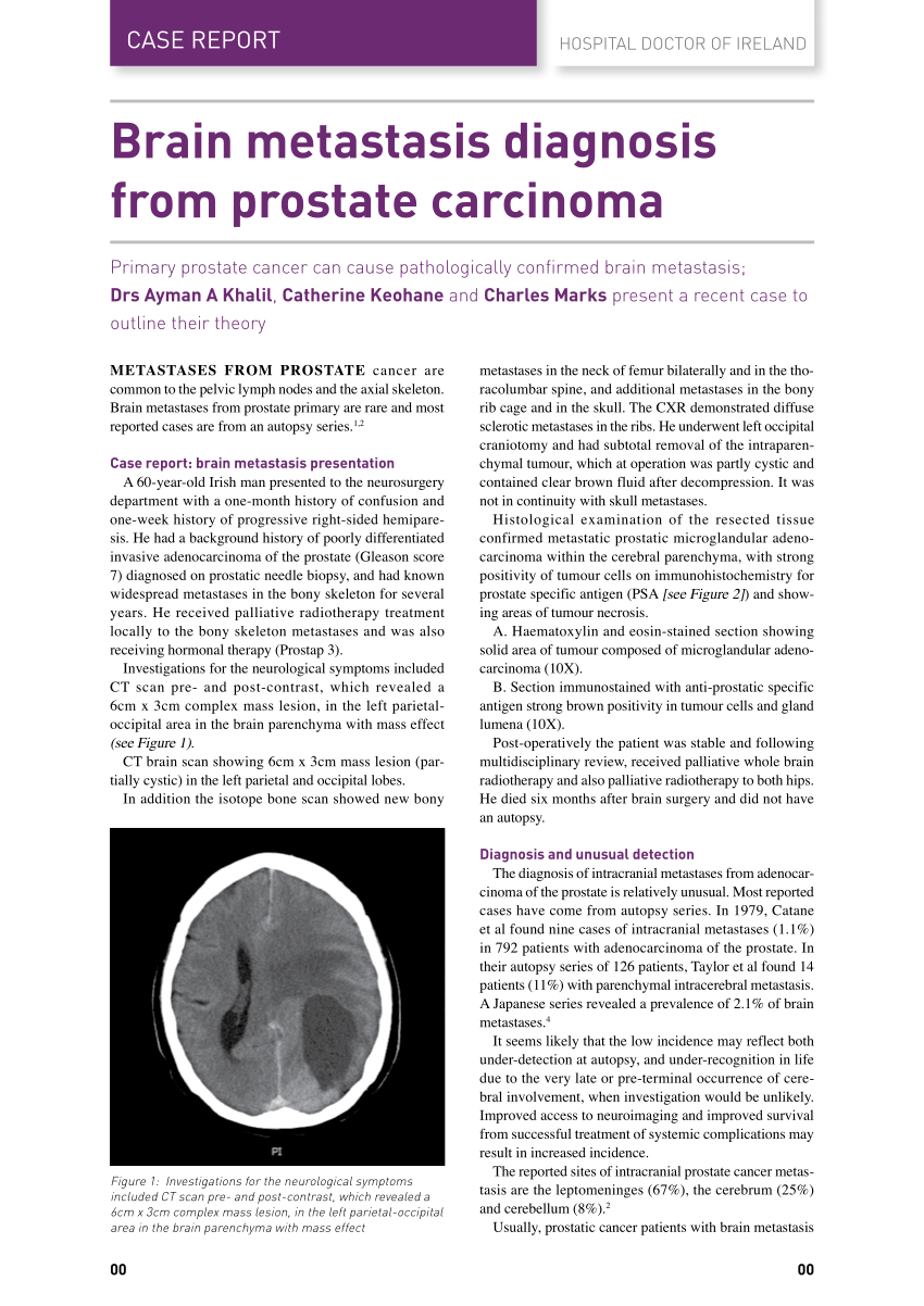 prostate cancer metastasis to brain ce să faci dacă ai prostatită