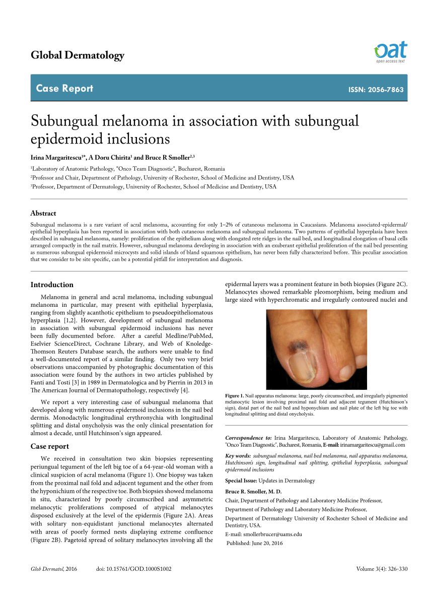 Pdf Subungual Melanoma In Association With Subungual Epidermoid