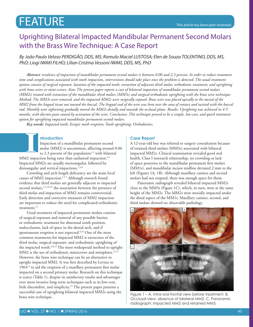 The treatment of impacted mandibular second molars using brass