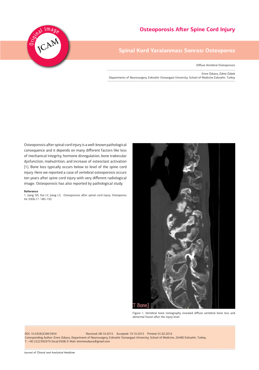 osteoporosis case study scribd