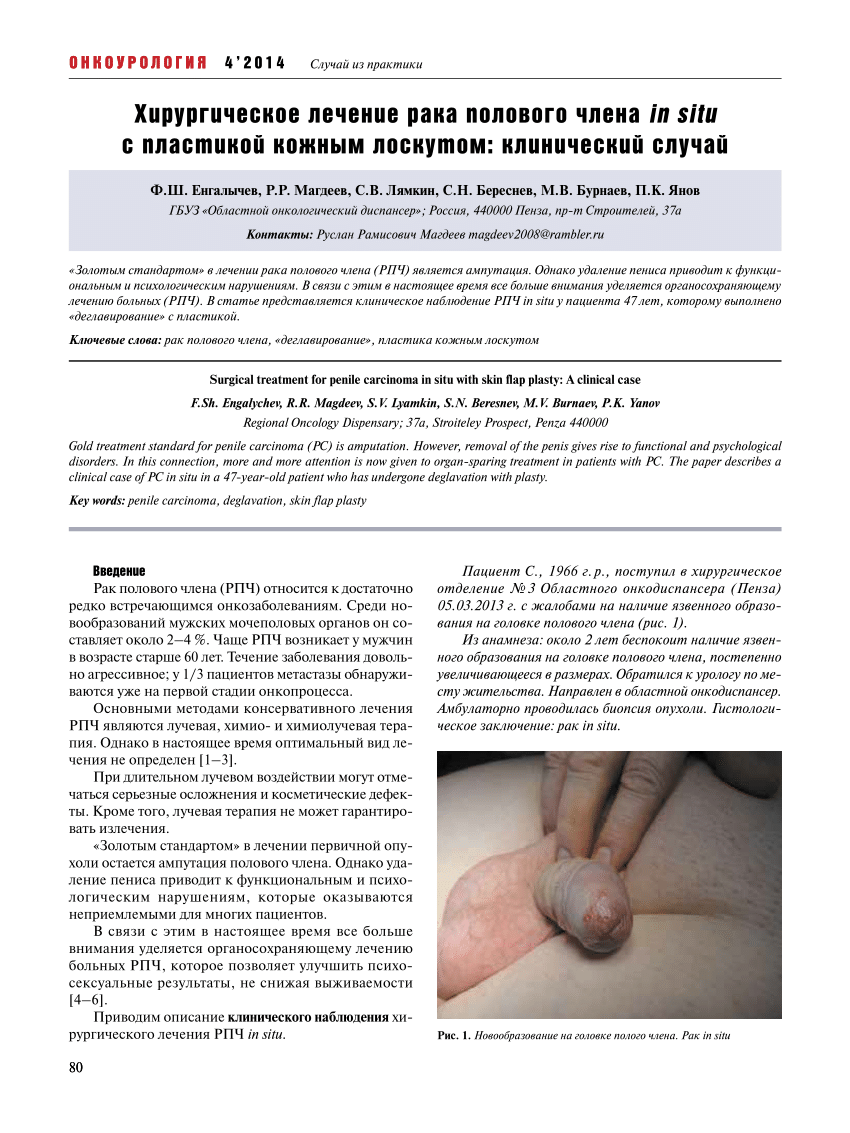 PDF) Surgical treatment for penile carcinoma in situ with skin flap plasty:  A clinical case