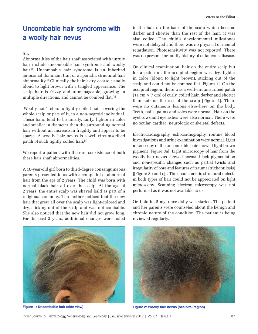 A girl with loose anagen hair syndrome and concurrent uncombable hair  syndrome  ScienceDirect
