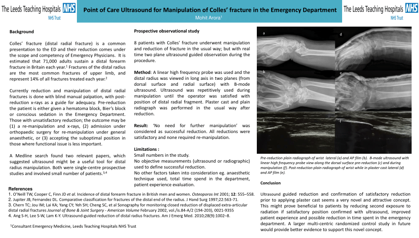 Colles fracture: Causes, presentation and management