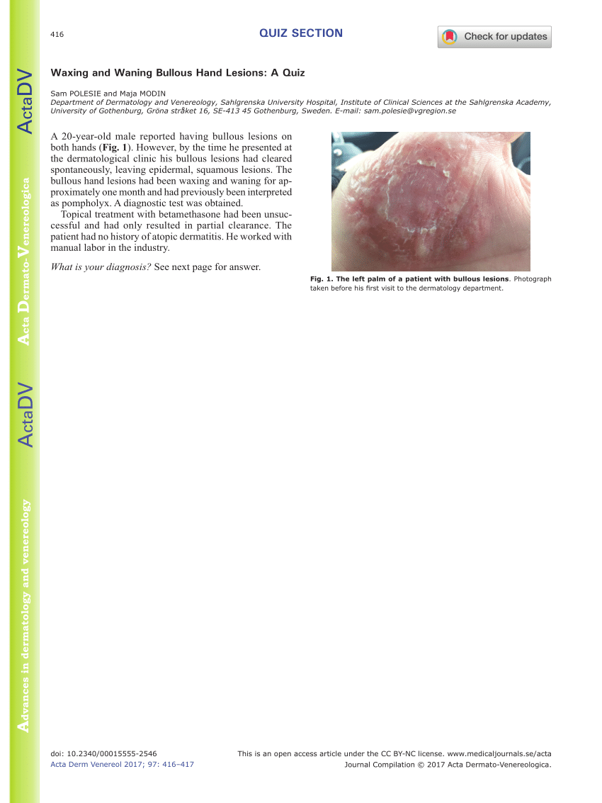 PDF] A Case of Tinea Manuum Caused by Trichophyton mentagropytes var.  erinacei