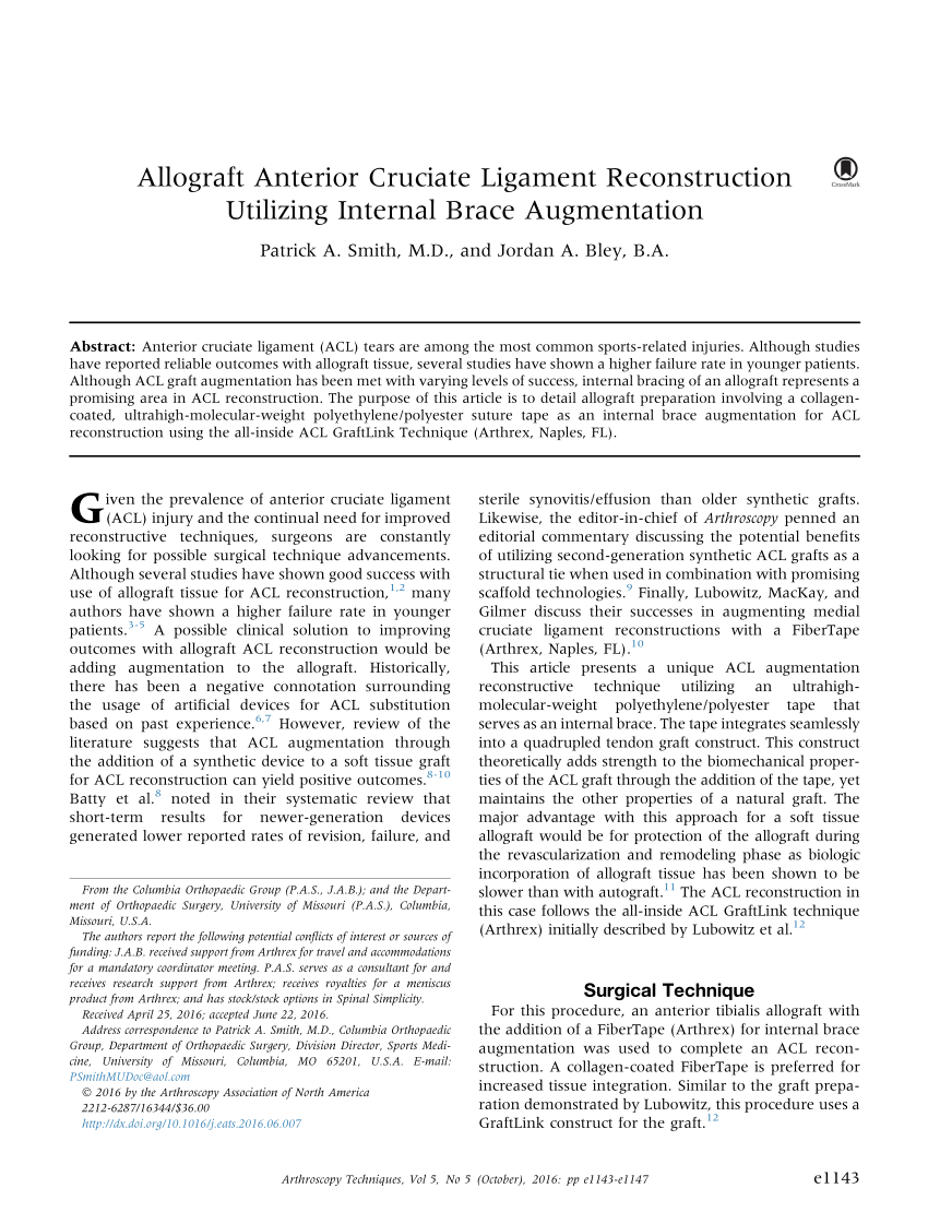 Arthrex - InternalBrace™ Ligament Augmentation Repair—Deltoid Ligament