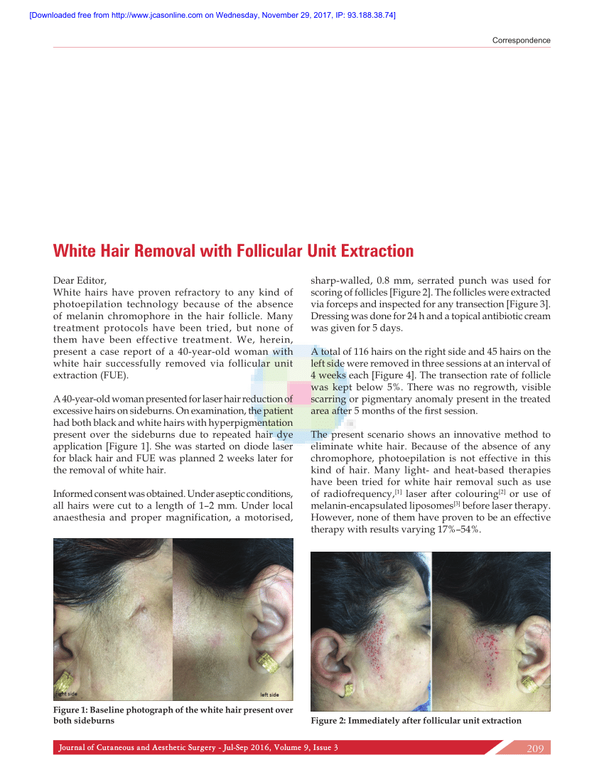 PDF) White Hair Removal with Follicular Unit Extraction
