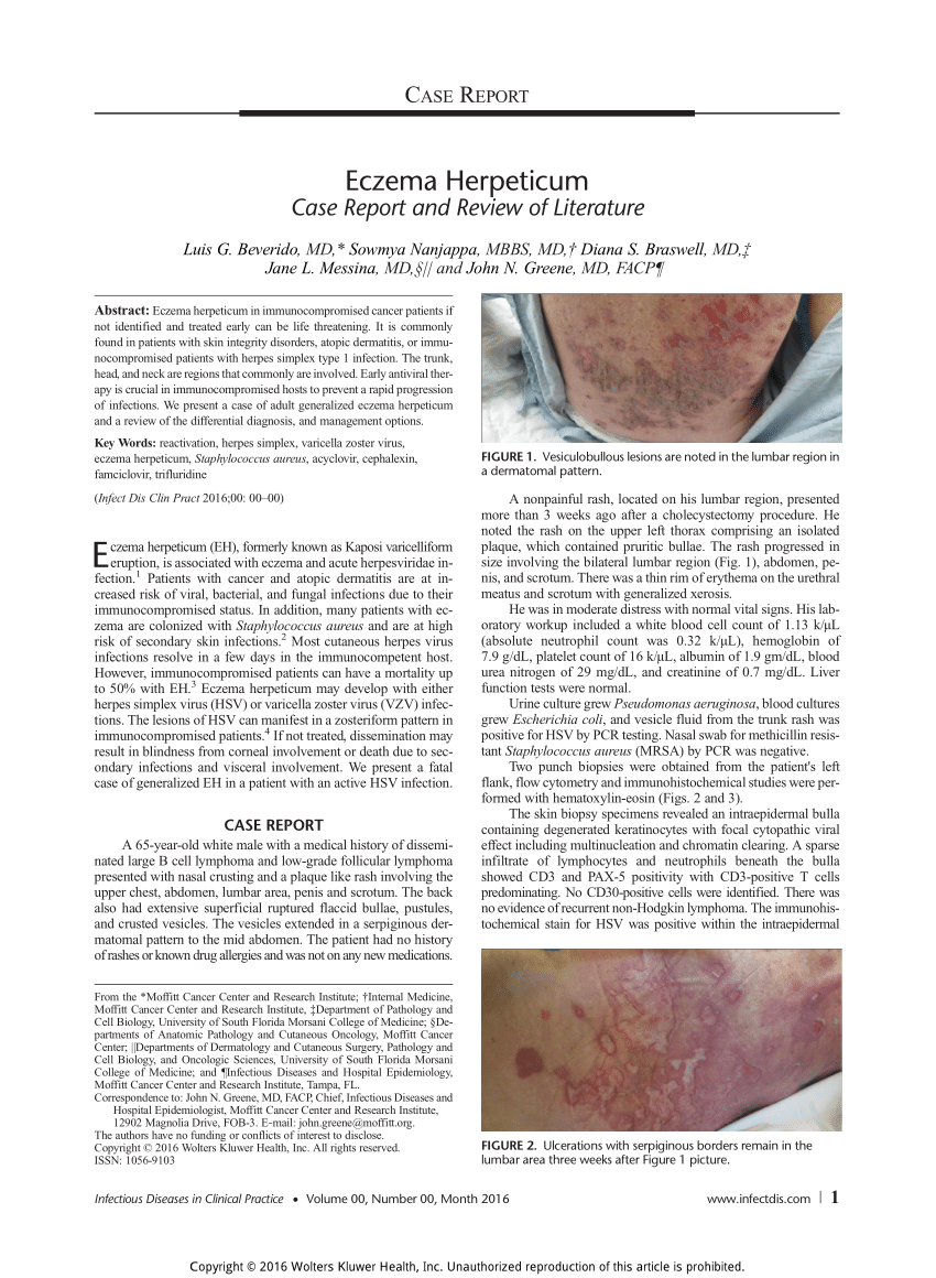Pdf Eczema Herpeticum A Case Report And Review Of Literature