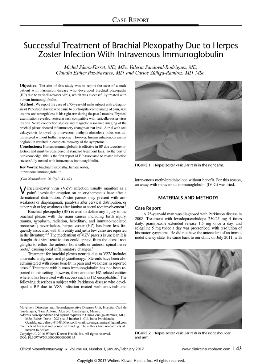 Pdf Successful Treatment Of Brachial Plexopathy Due To Herpes Zoster Infection With Intravenous Immunoglobulin