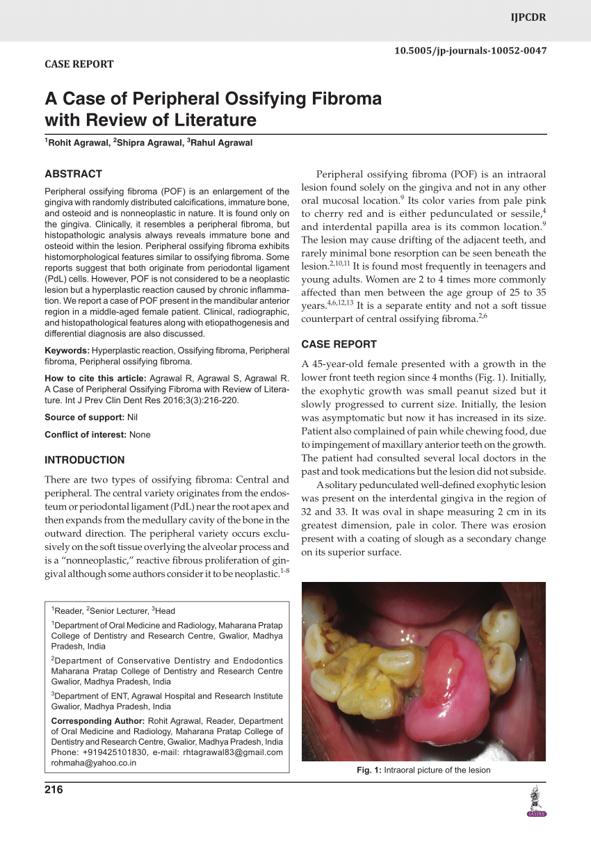 peripheral ossifying fibroma case report and literature review