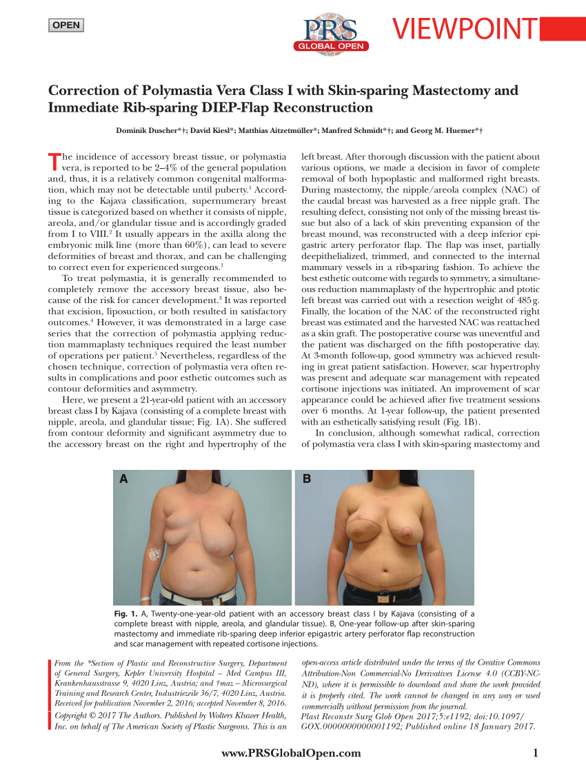 Breast Asymmetry Correction - Este Pro Clinic