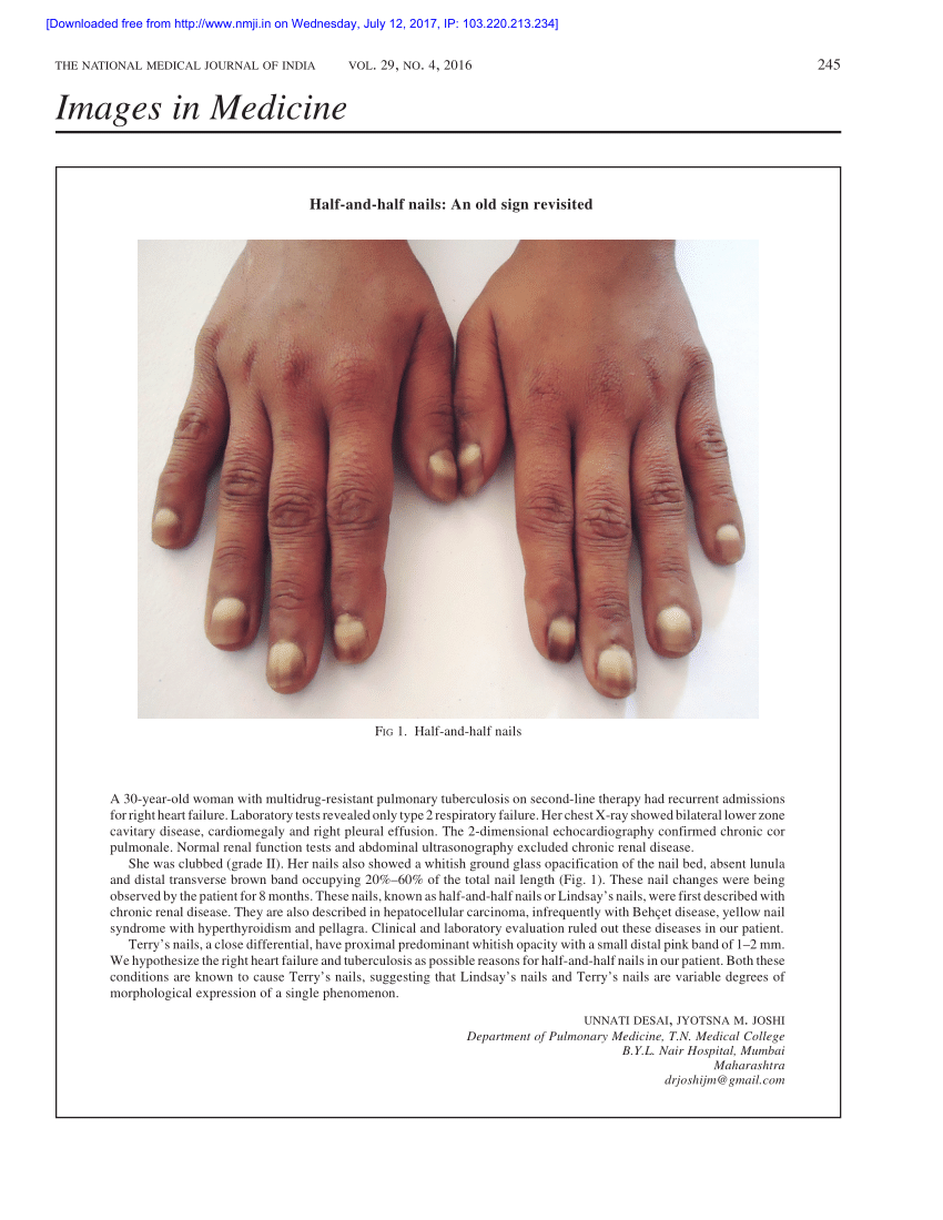 Woman's Nails Slowly Turning White - Let's Diagnose | VisualDx