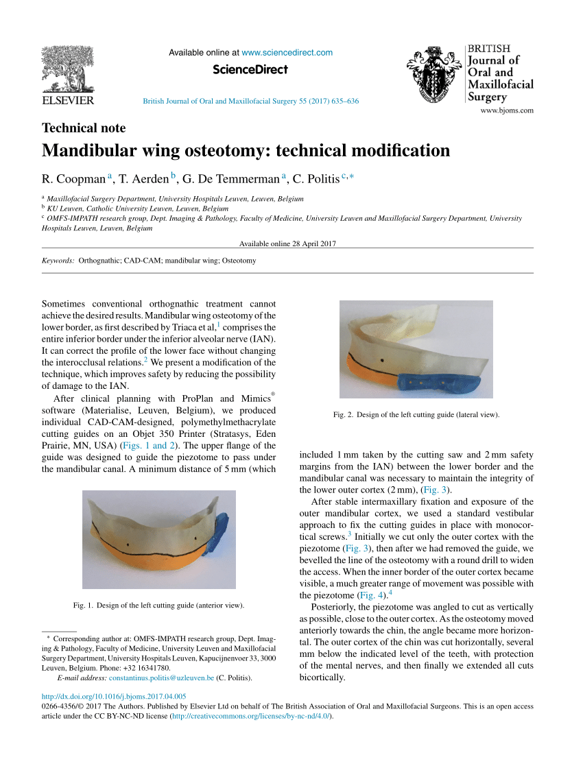 (PDF) Mandibular wing osteotomy: Technical modification - Largepreview