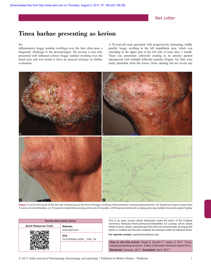 PDF) Tinea barbae presenting as kerion