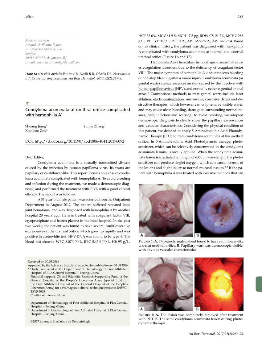 condyloma acuminatum urethra cancer hodgkin linfatico
