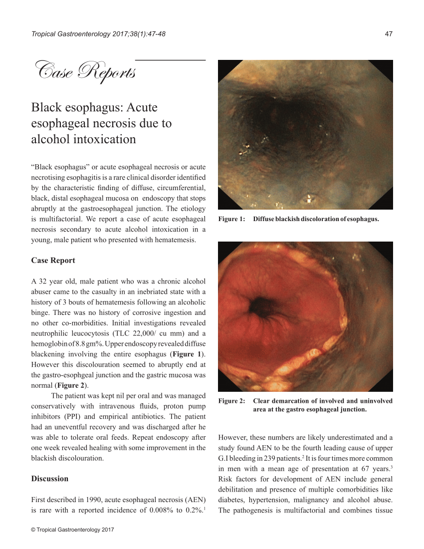 (PDF) Black esophagus Acute esophageal necrosis due to