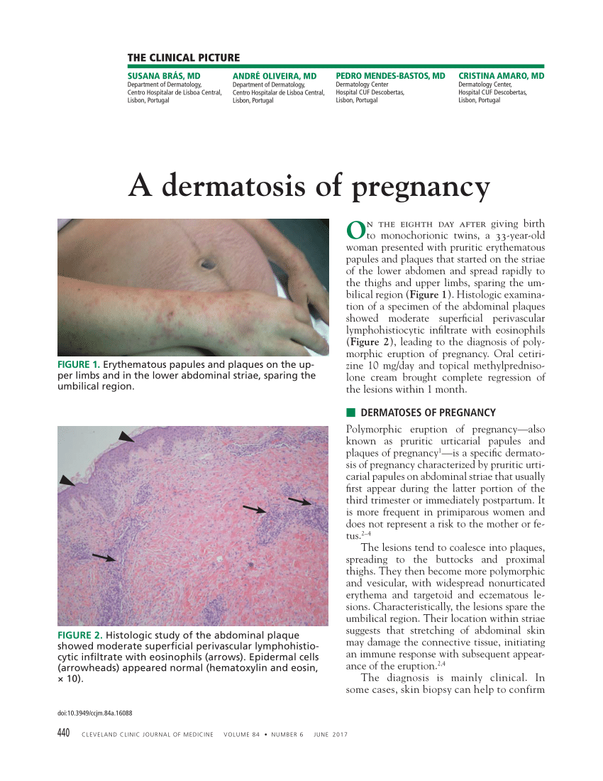 Pregnancy Dermatoses