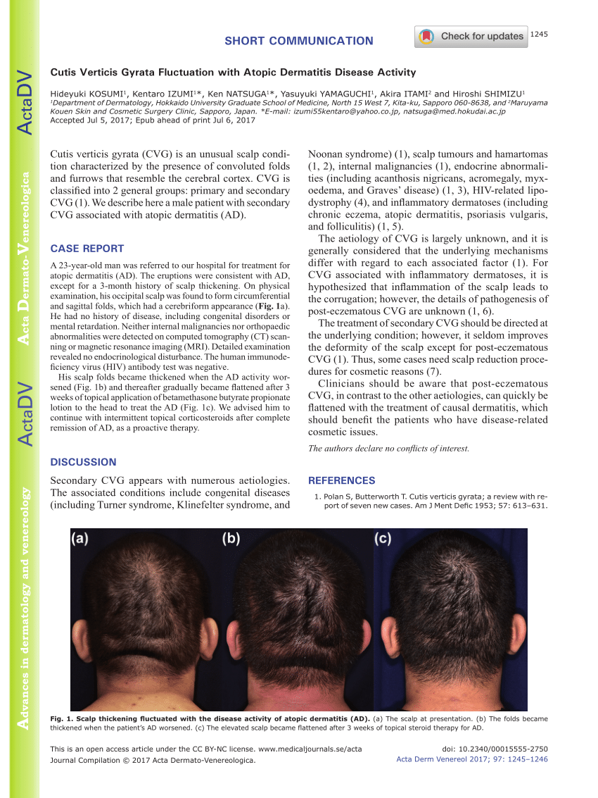 (PDF) Cutis Verticis Gyrata Fluctuation with Atopic Dermatitis Disease ...