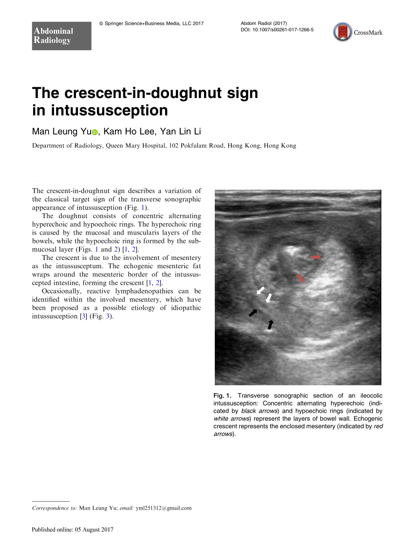 intussusception crescent sign