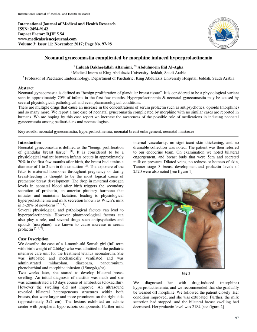 PDF Neonatal Gynecomastia Complicated By Morphine Induced Hyperprolactinemia