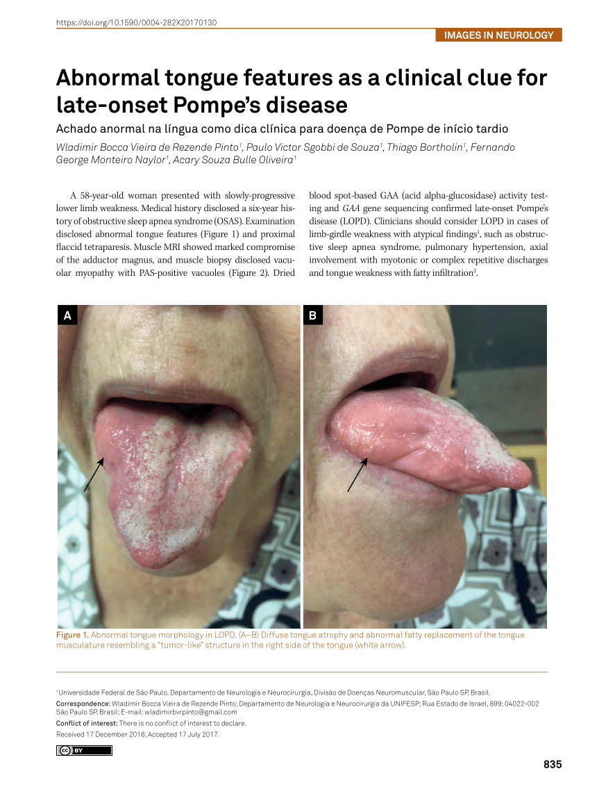 (PDF) Abnormal tongue features as a clinical clue for late-onset Pompe
