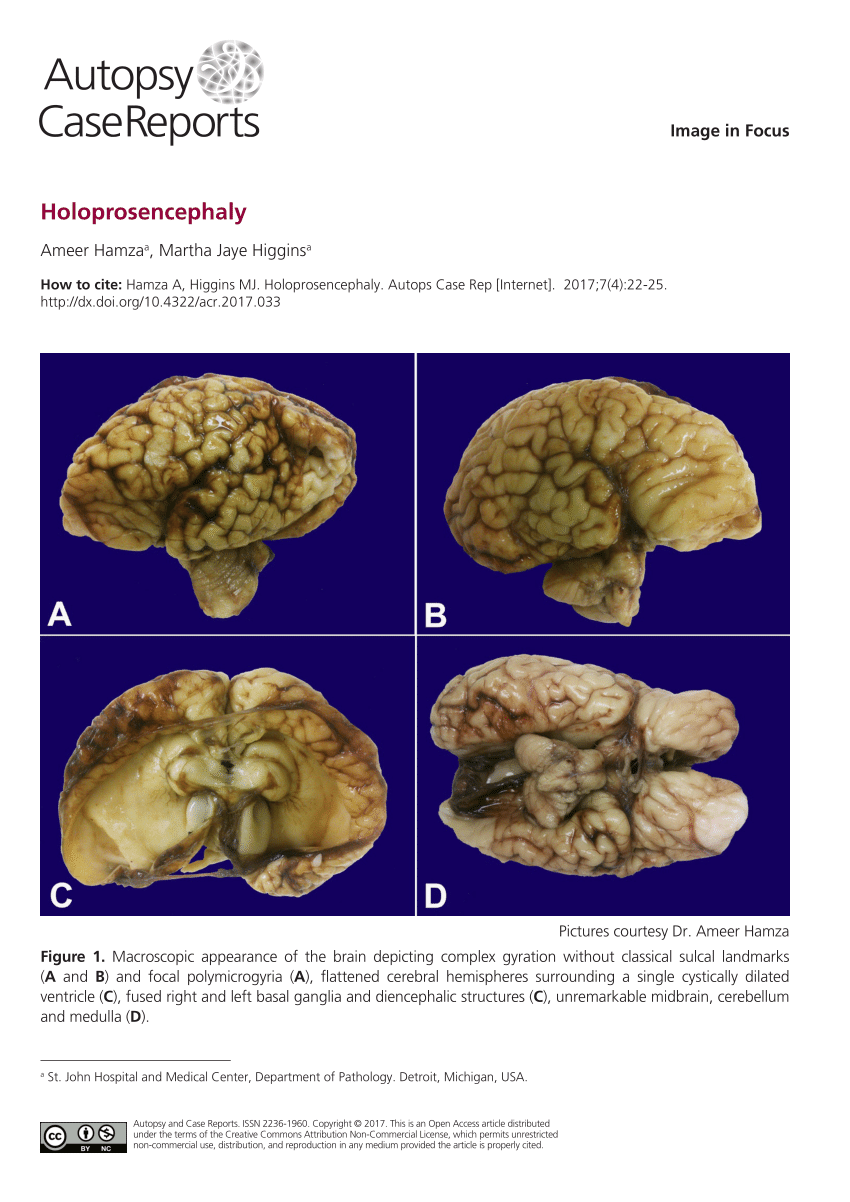holoprosencephaly brain