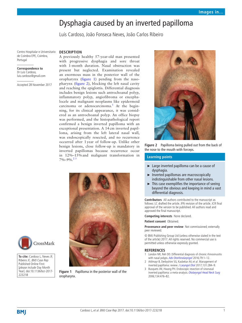nasal inverted papilloma causes)