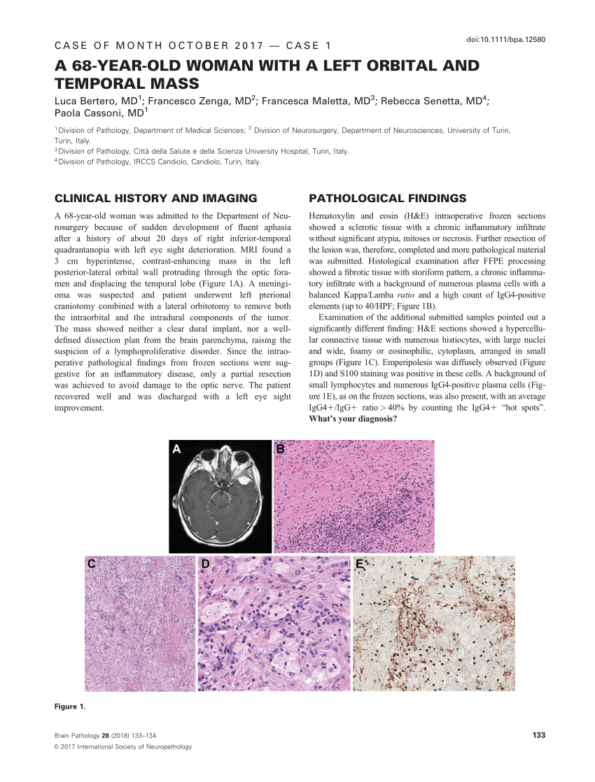 Pdf A 68 Year Old Woman With A Left Orbital And Temporal Mass Correspondence 7779