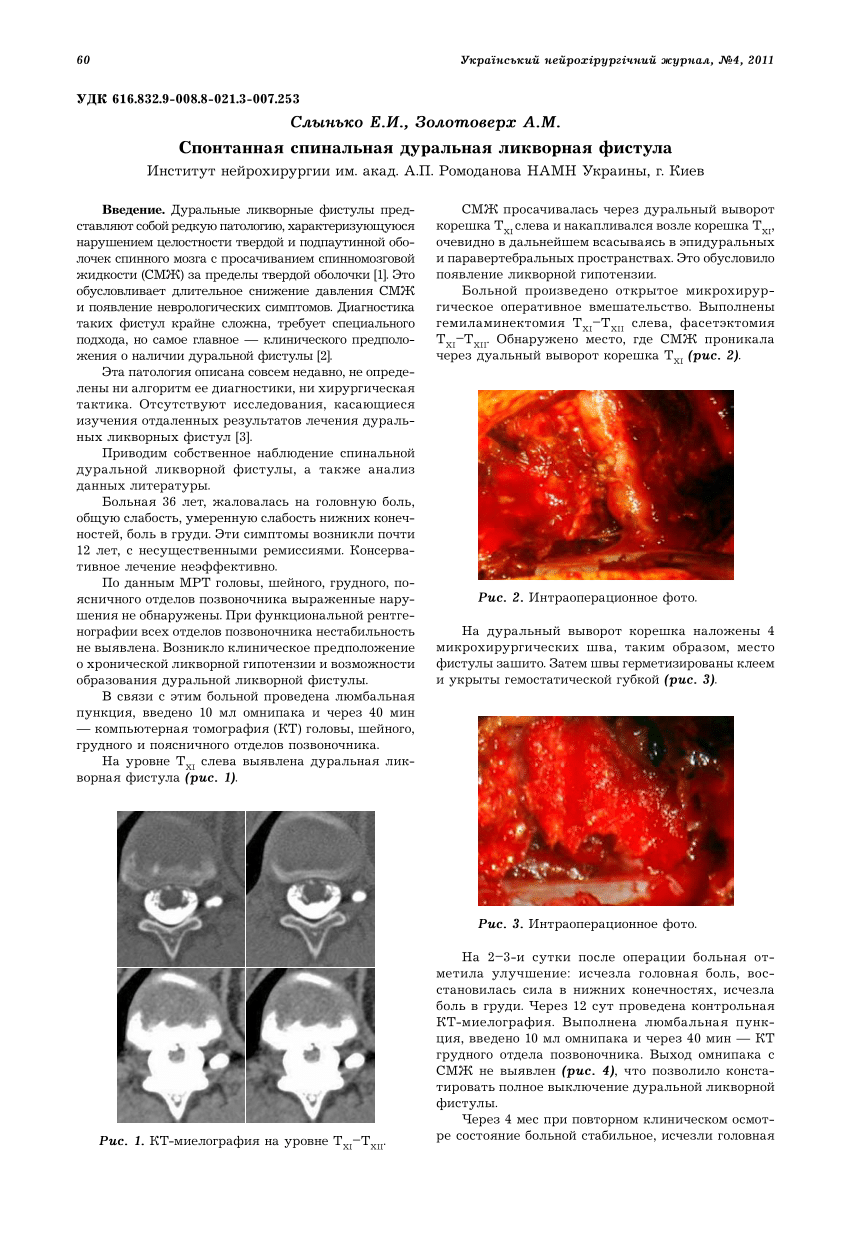 PDF) Spontaneous spinal liquor fistula: case report