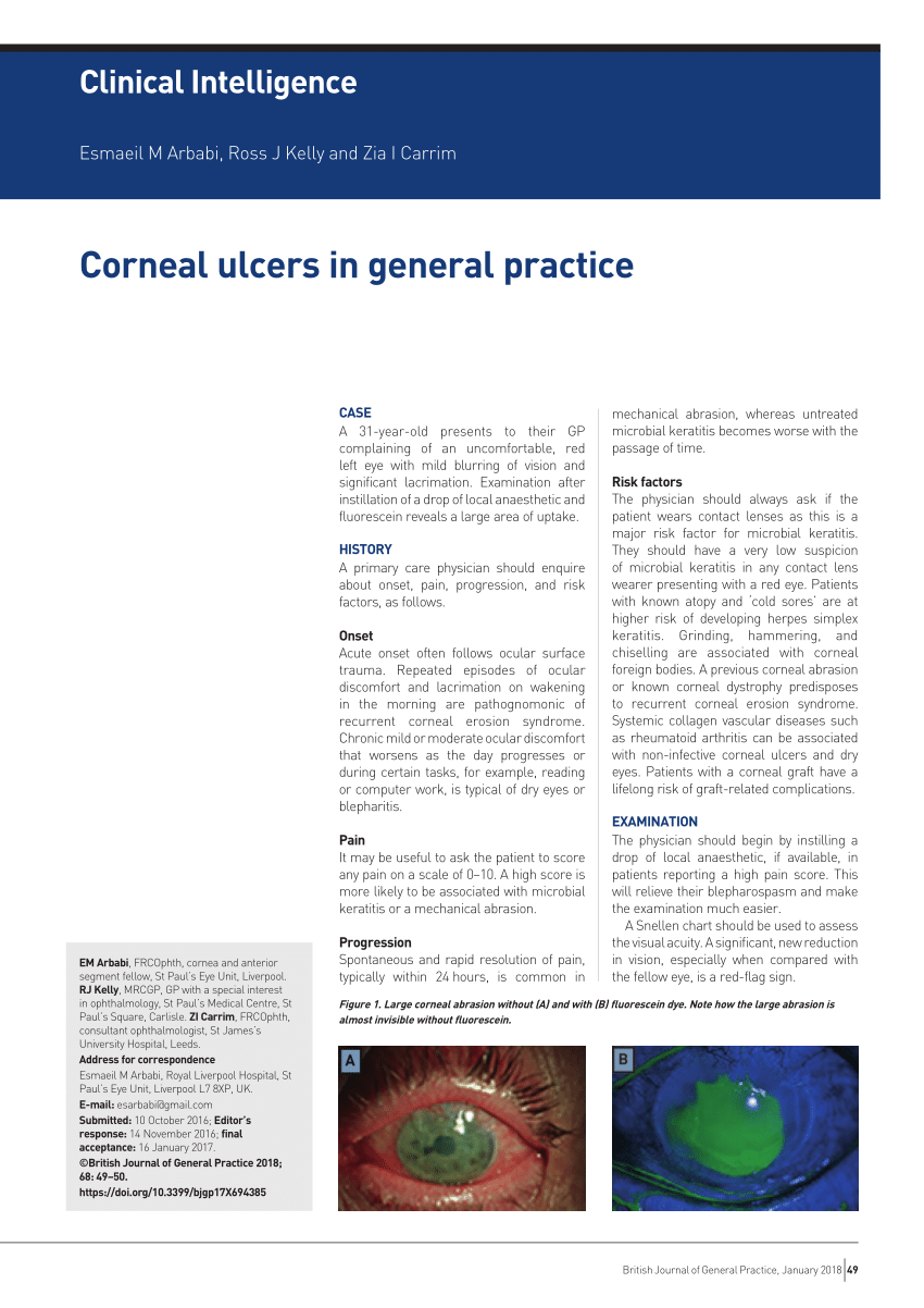 thesis on corneal ulcers