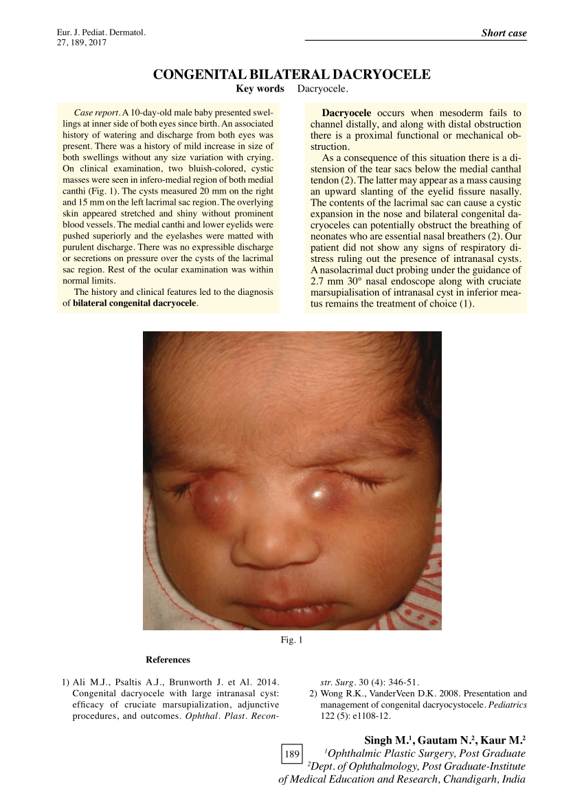 Pdf Congenital Bilateral Dacryocele 