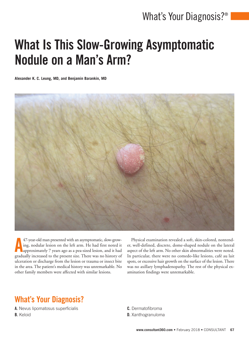 Pdf What Is This Slow Growing Asymptomatic Nodule On A Mans Arm
