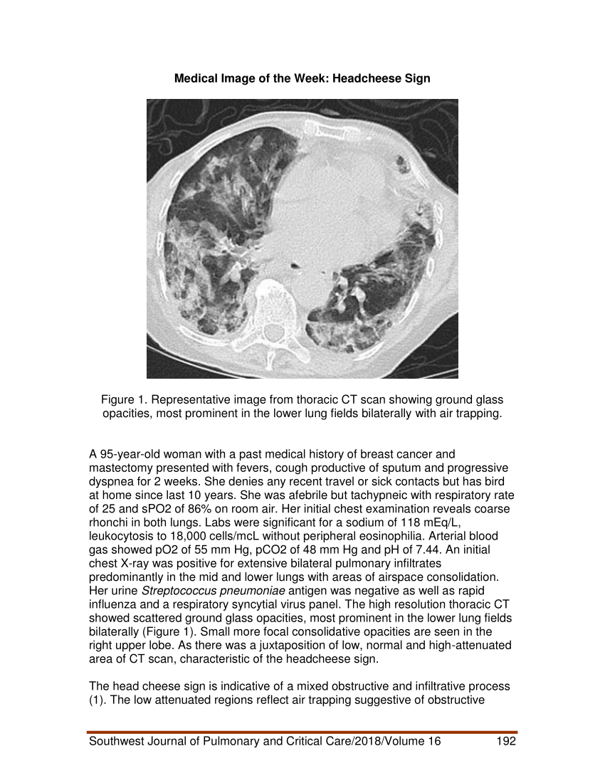 (PDF) Medical image of the week: headcheese sign