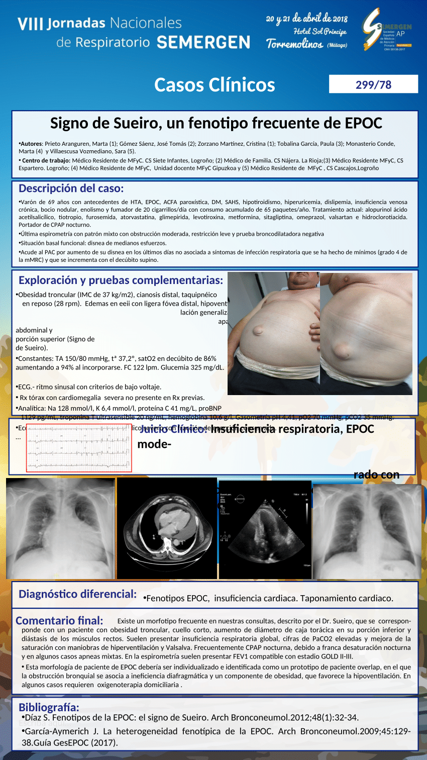 Pdf Signo De Sueiro Un Fenotipo Frecuente De Epoc