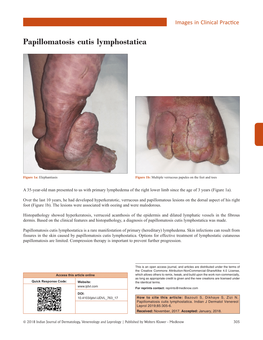 Lymphatic papillomatosis treatment