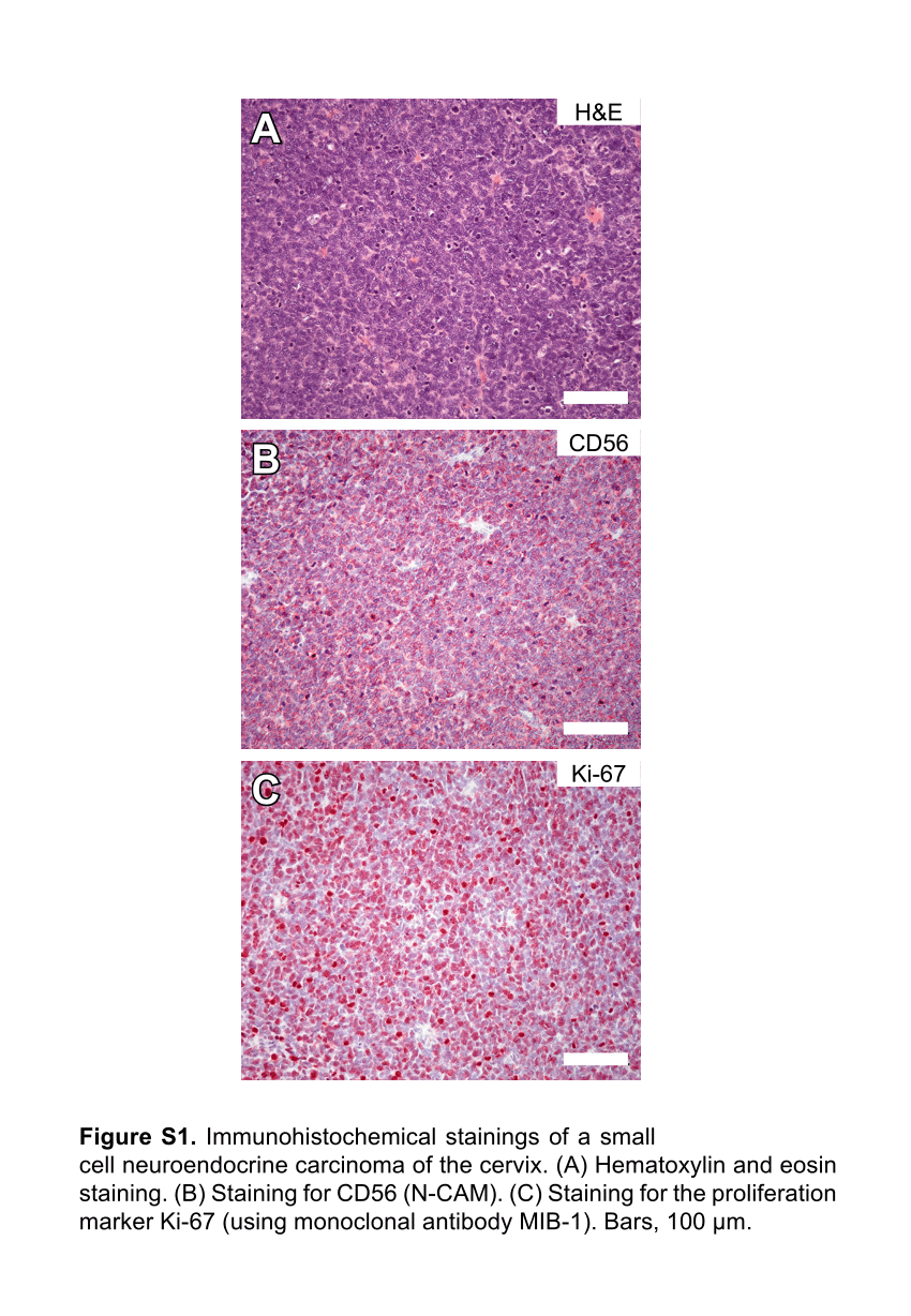 Cancer pancreas metastase foie survie - Cancer neuroendocrine a petite cellule