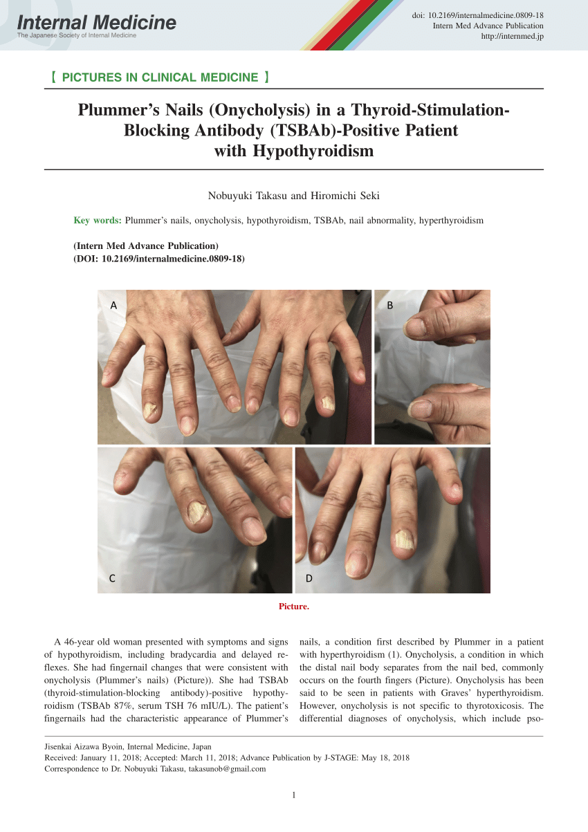 Pdf Plummer S Nails Onycholysis In A Thyroid Stimulation Blocking Antibody Tsbab Positive Patient With Hypothyroidism