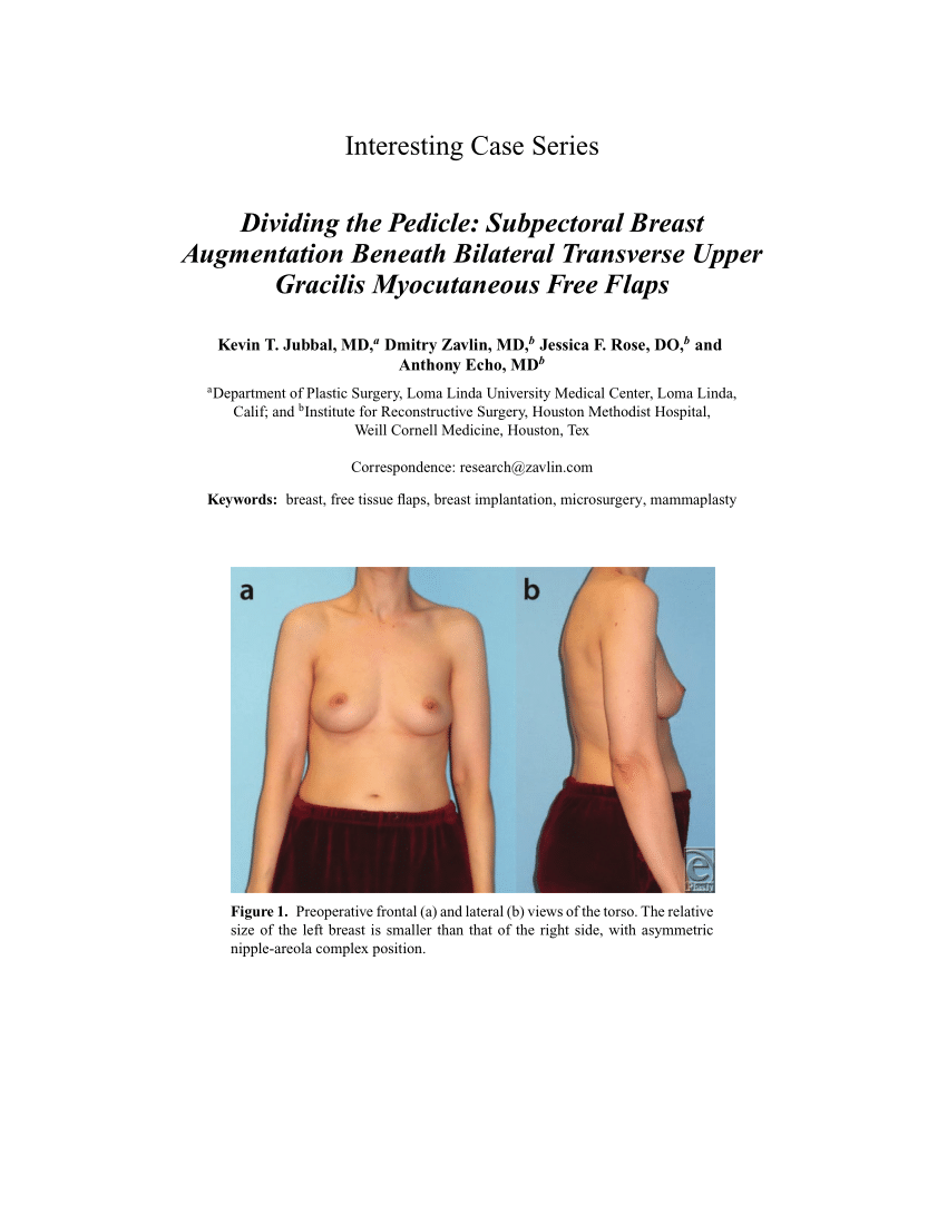 Asymmetrical Breasts  Plastic Surgery Group of Rochester