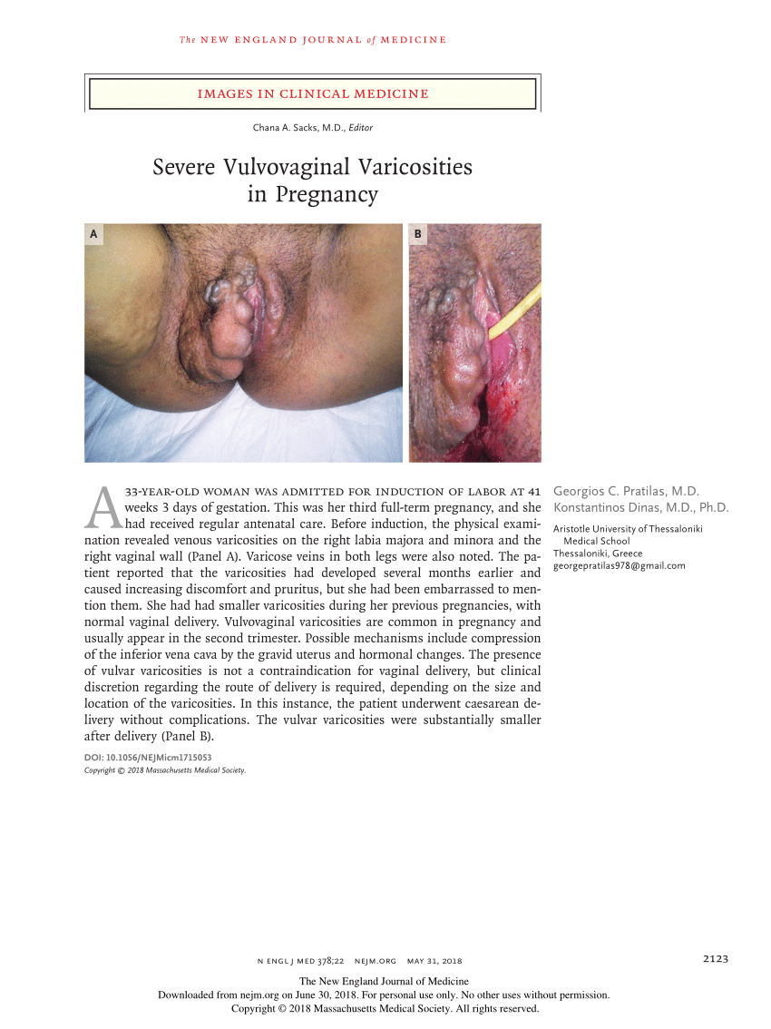 A medence varikoózisa szülés után, A kismedencei szervek varikózisai a szülés után