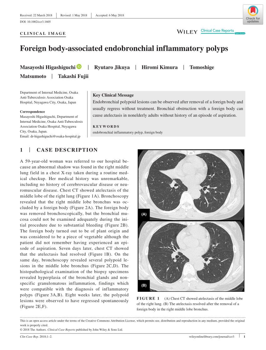 Pdf Foreign Body‐associated Endobronchial Inflammatory Polyps 8374
